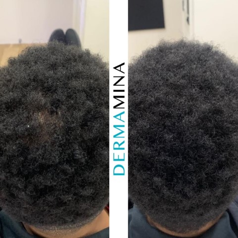 PRP hair treatment result