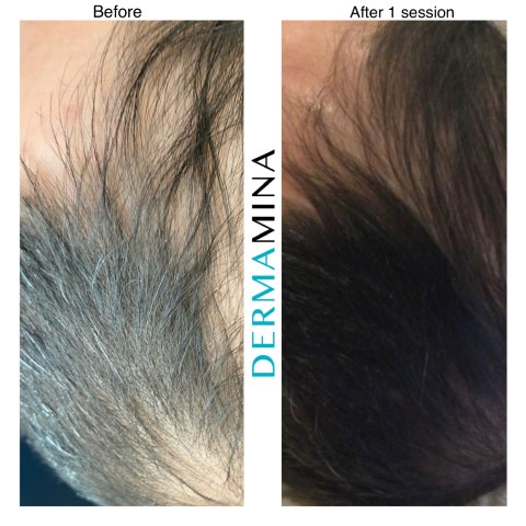 PRP hair treatment result