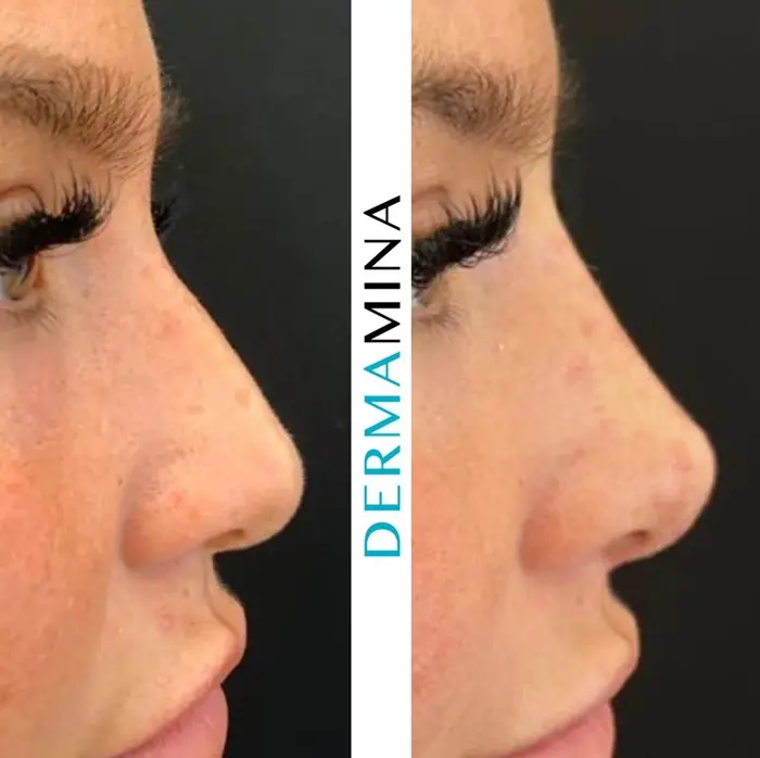 Non-surgical rhinoplasty before and after result 1