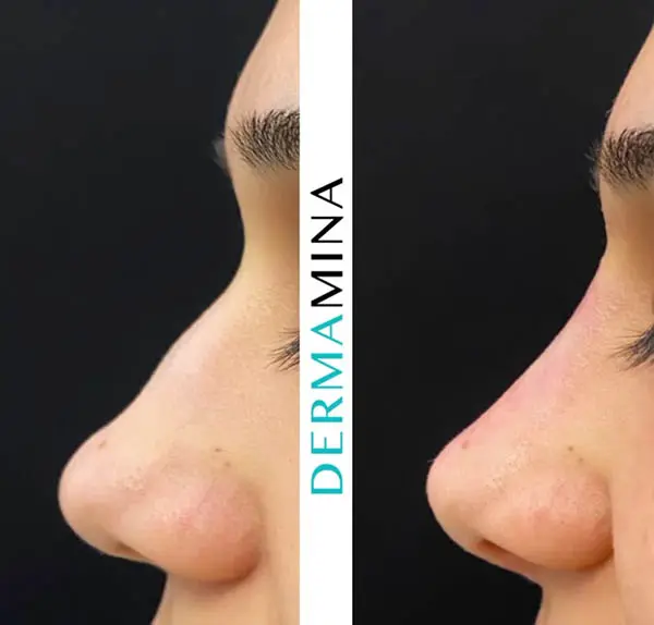 Non-surgical rhinoplasty before and after result 2