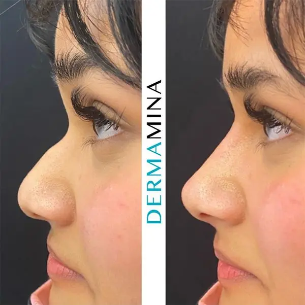 Non-surgical rhinoplasty before and after result 4