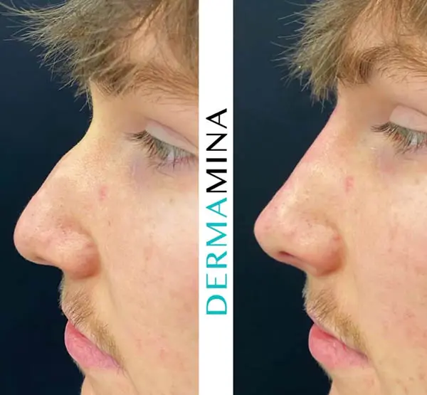 Non-surgical rhinoplasty before and after result 3