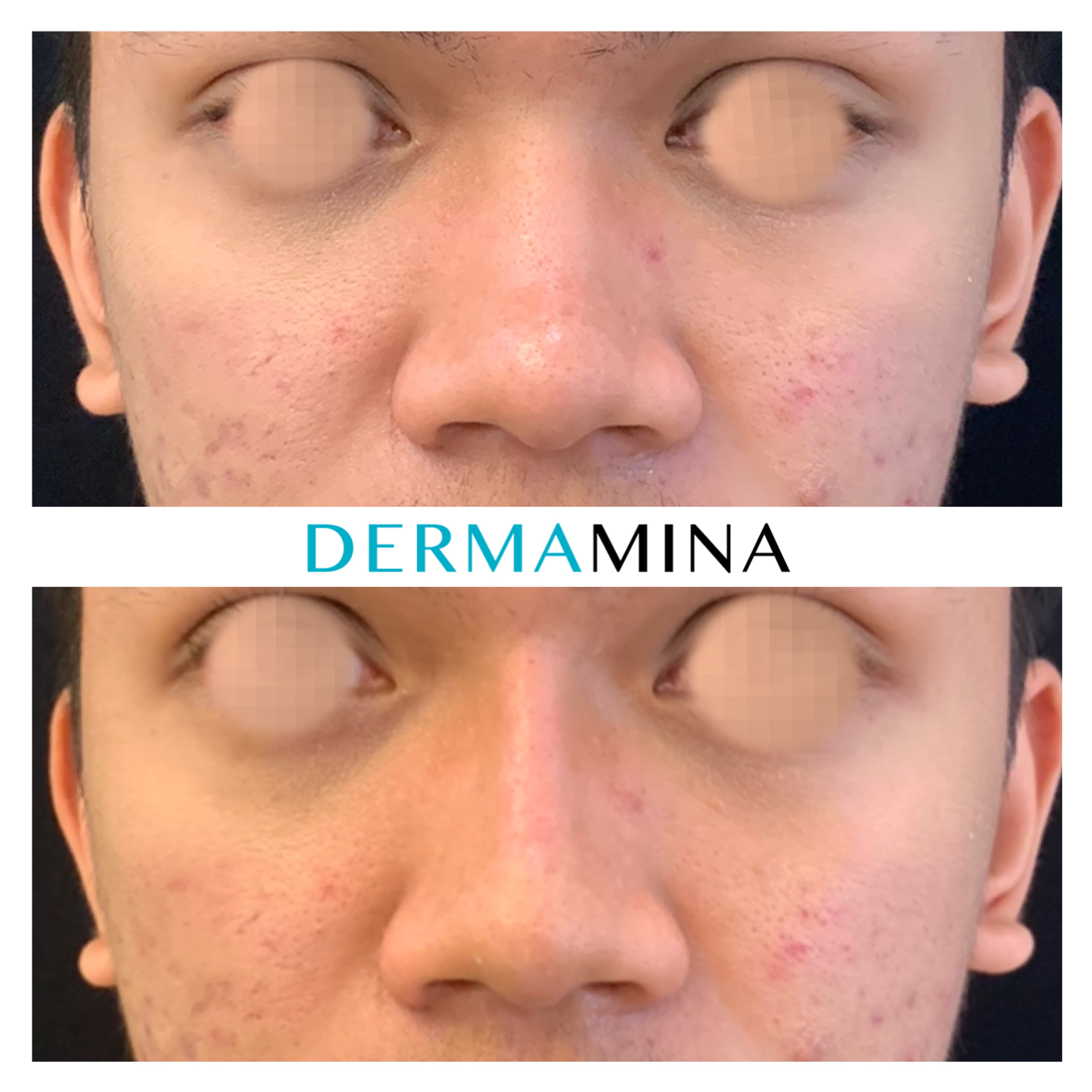 Before and after non-surgical rhinoplasty