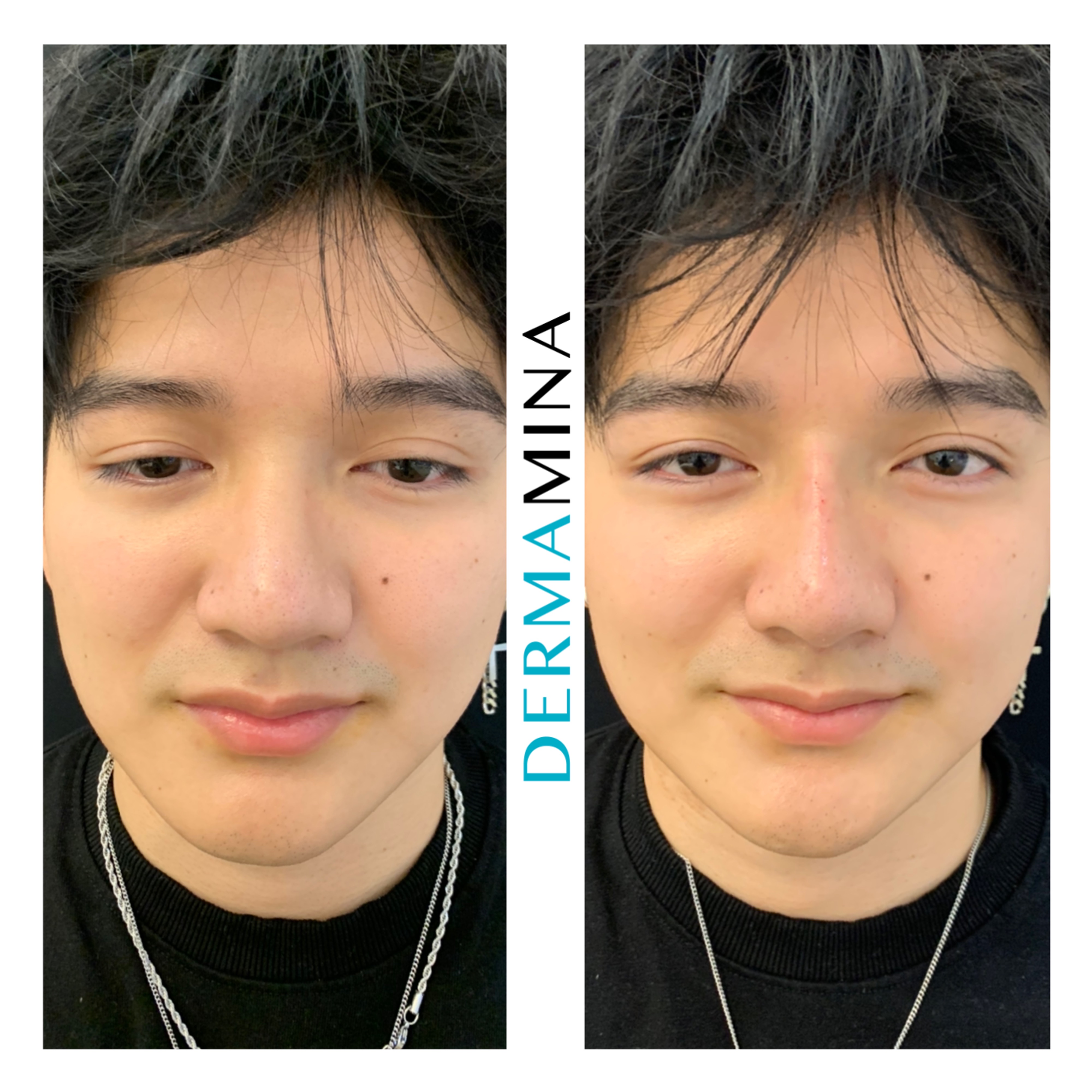 Before and after non-surgical rhinoplasty