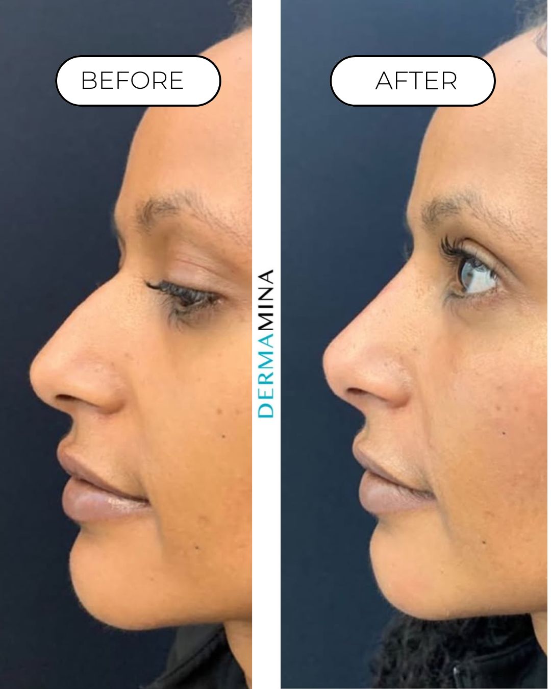 Before and after non-surgical rhinoplasty