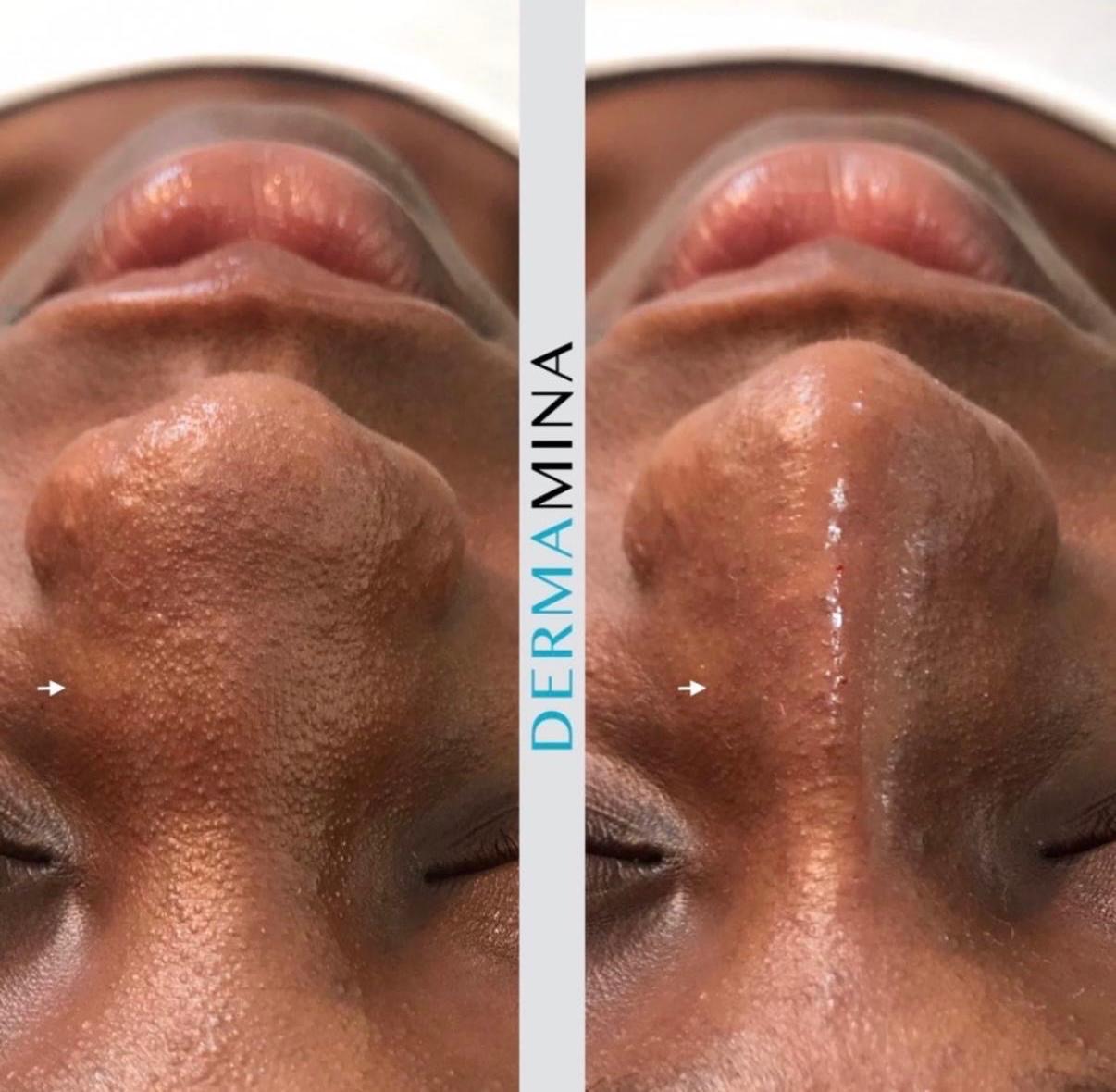 Before and after non-surgical rhinoplasty