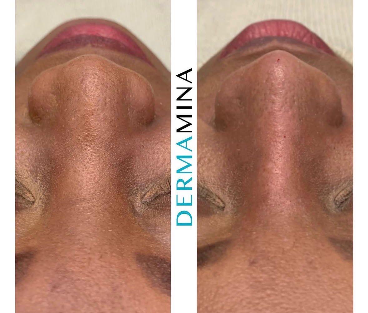 Before and after non-surgical rhinoplasty