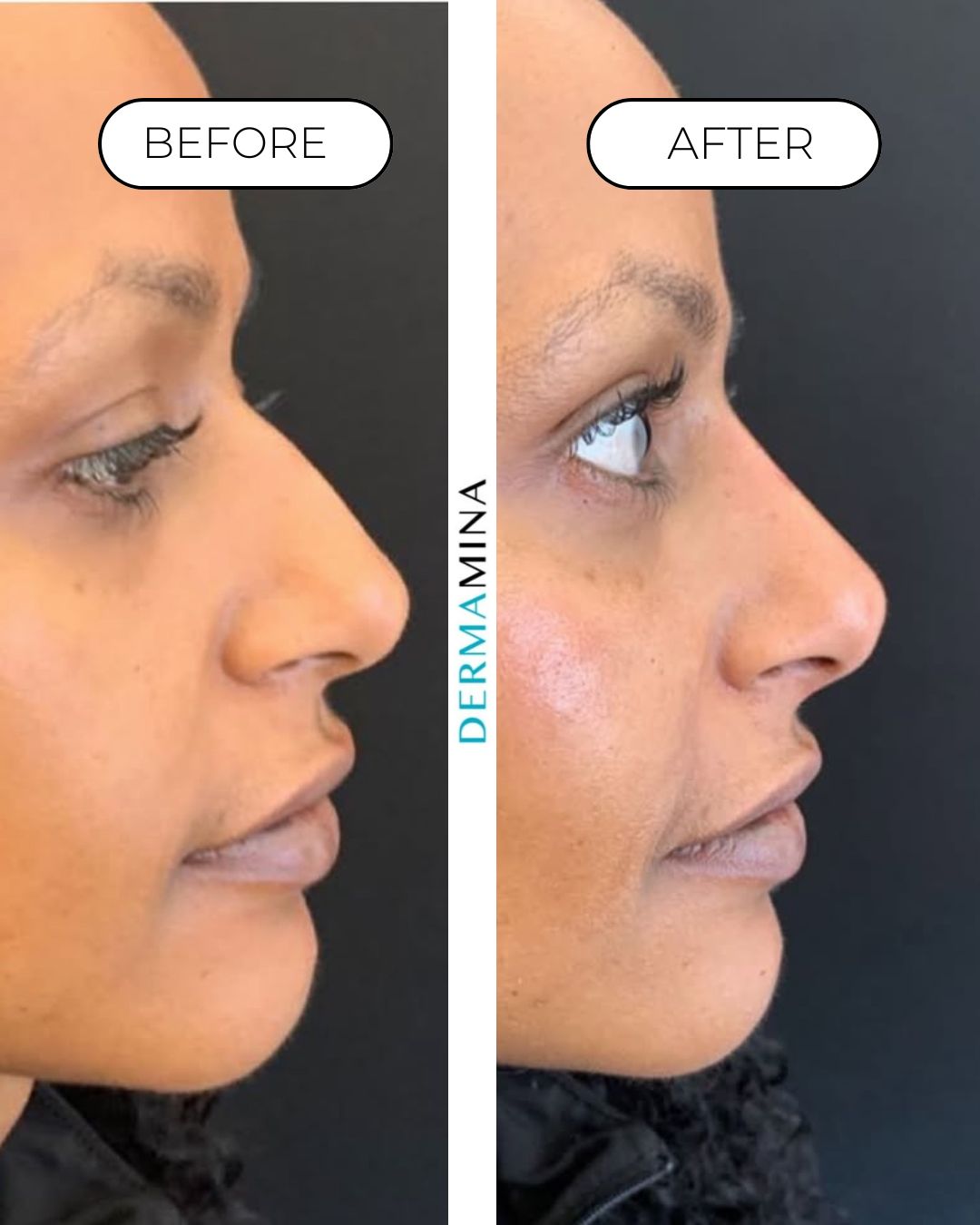Before and after non-surgical rhinoplasty