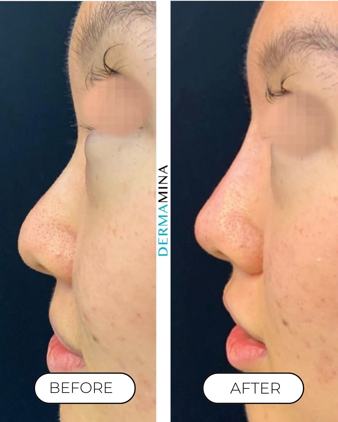 Before and after non-surgical rhinoplasty