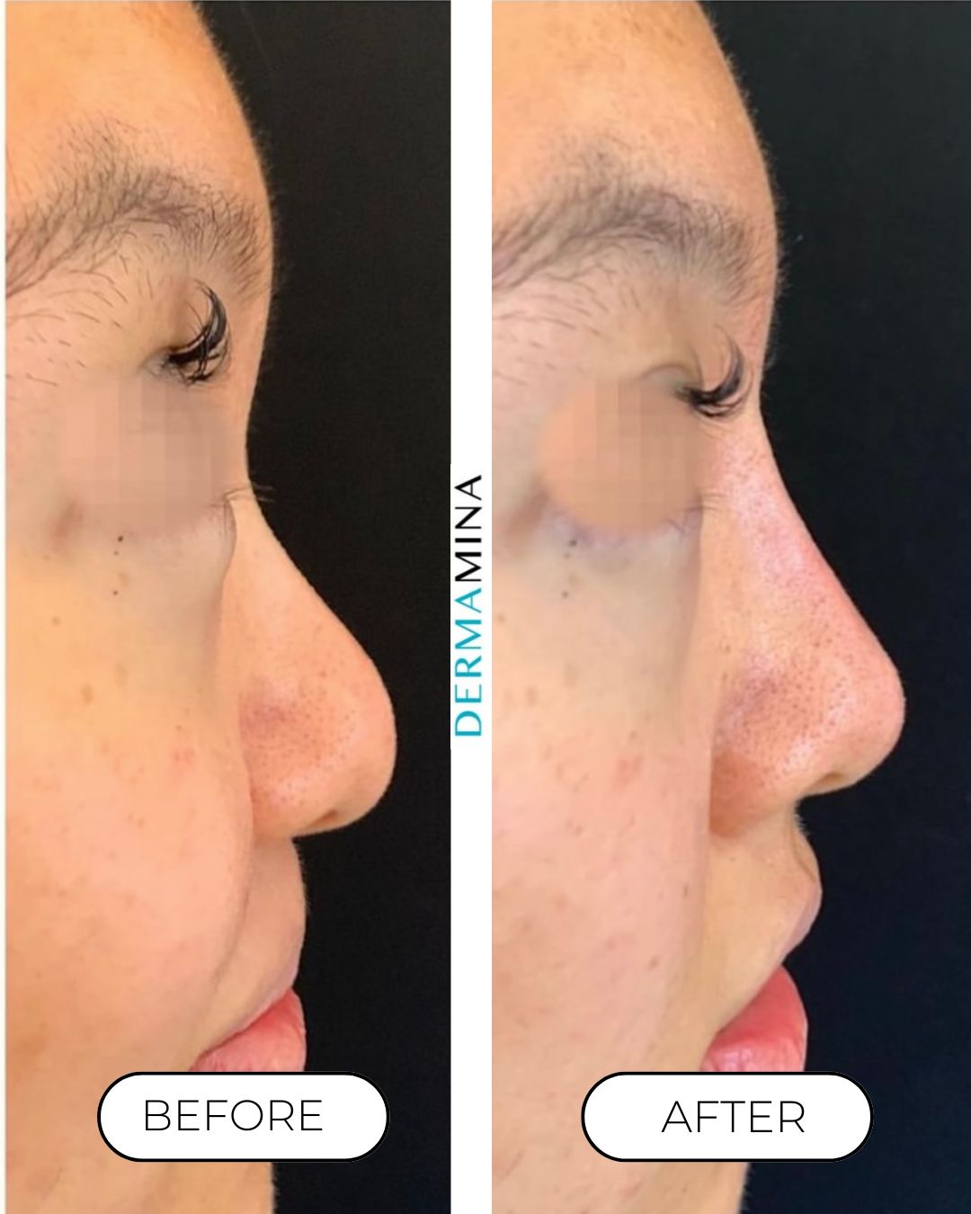 Before and after non-surgical rhinoplasty