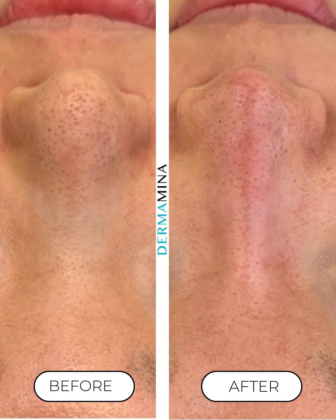 Before and after non-surgical rhinoplasty