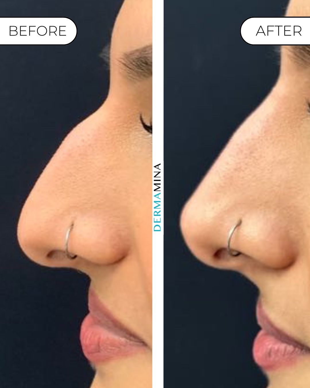 Before and after non-surgical rhinoplasty