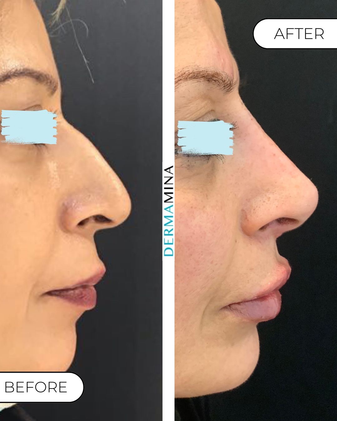Before and after non-surgical rhinoplasty