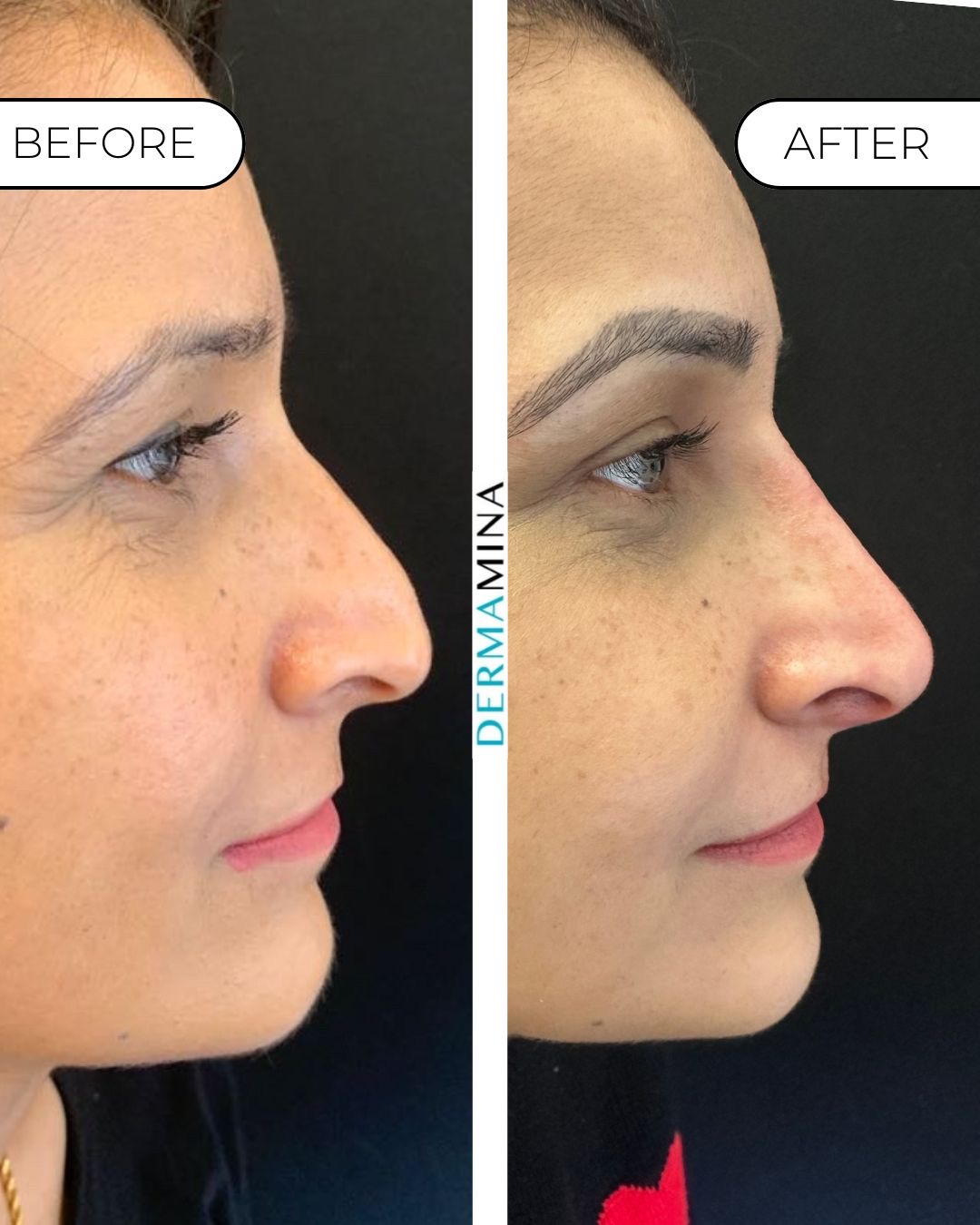 Before and after non-surgical rhinoplasty