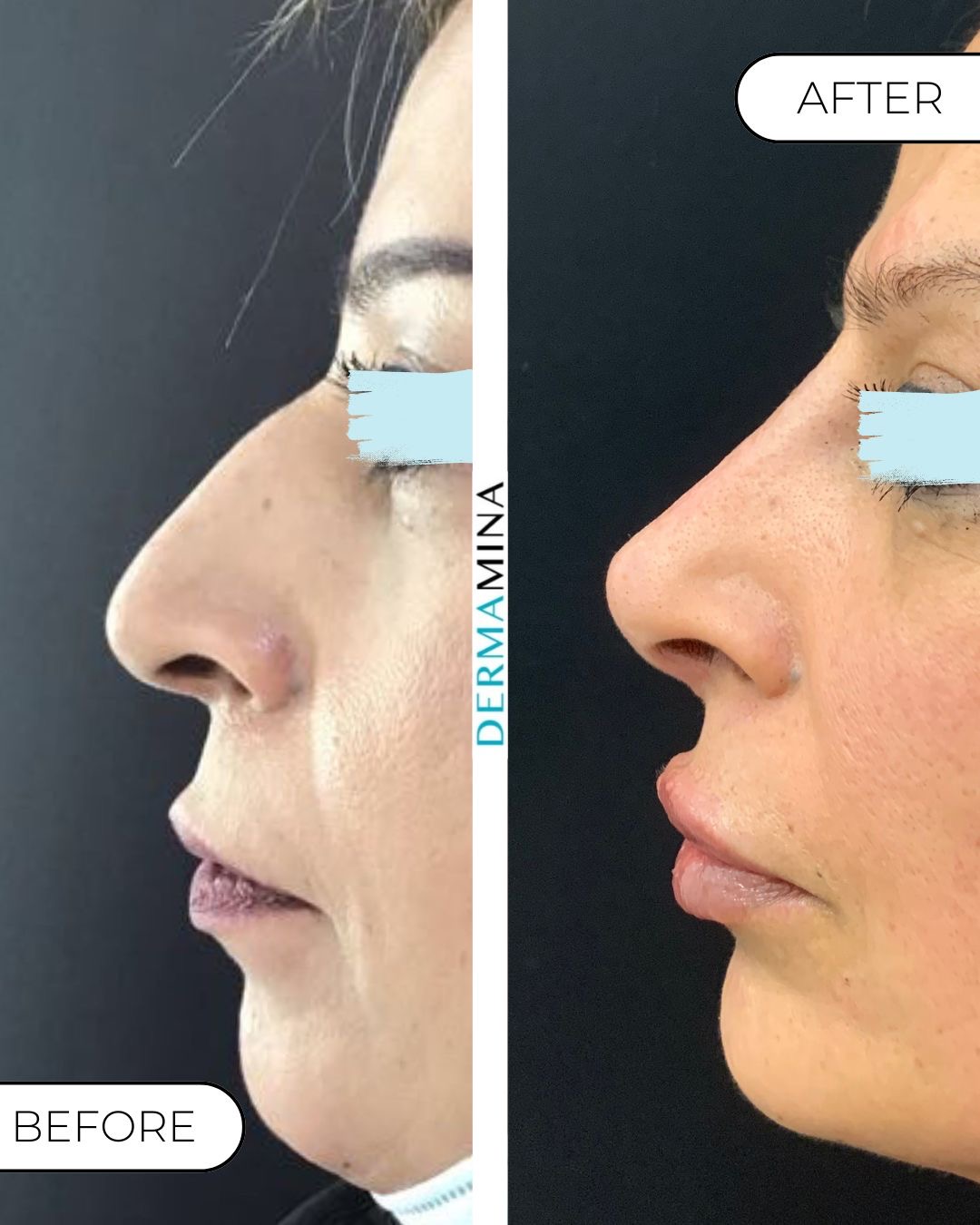 Before and after non-surgical rhinoplasty