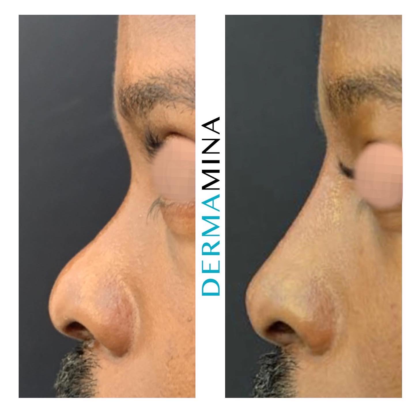 Before and after non-surgical rhinoplasty