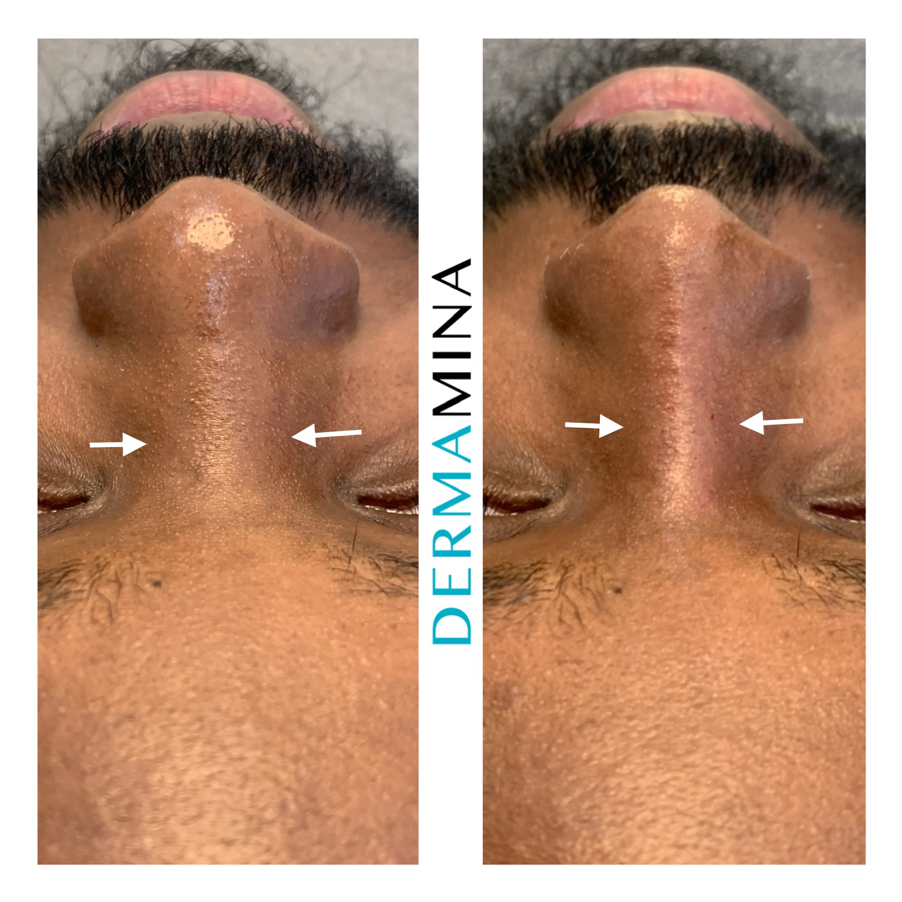Before and after non-surgical rhinoplasty