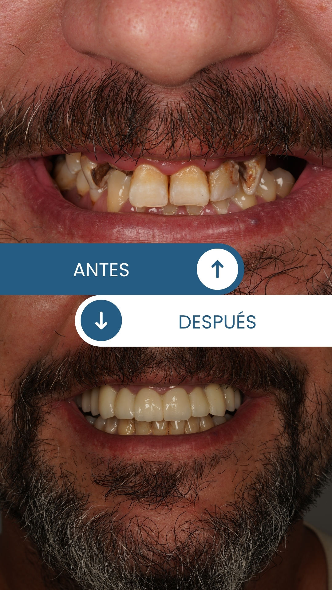 Caso real de rehabilitación oral 4