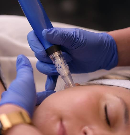 SkinPen skin needling treatment at Paulina de los Reyes