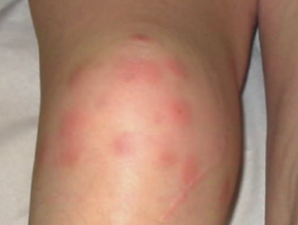 mistletoe injection for osteoarthritis 