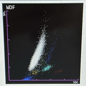 Scattergram WDF Sysmex — Série branca alterada