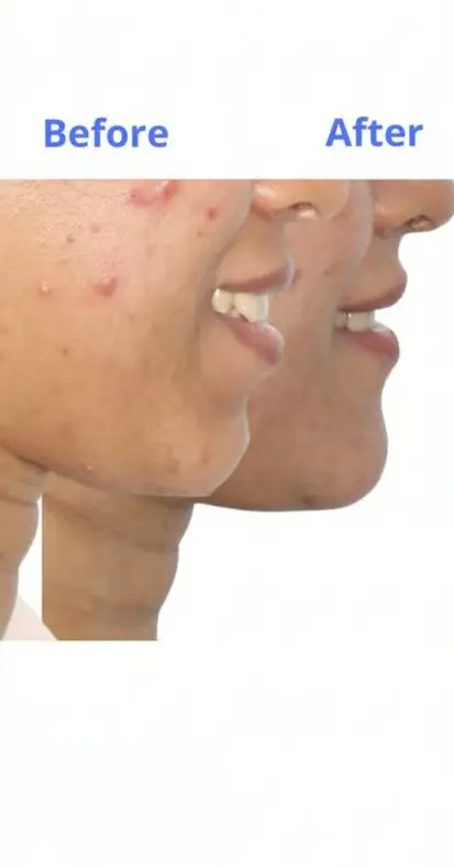 Patient smile transformation 9