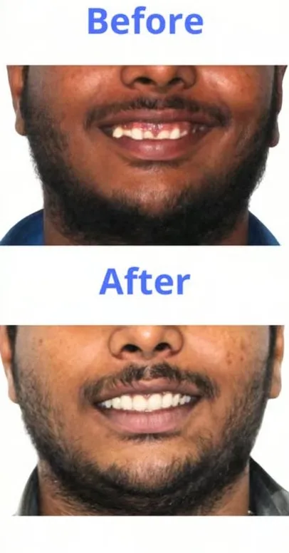 Patient smile transformation 3