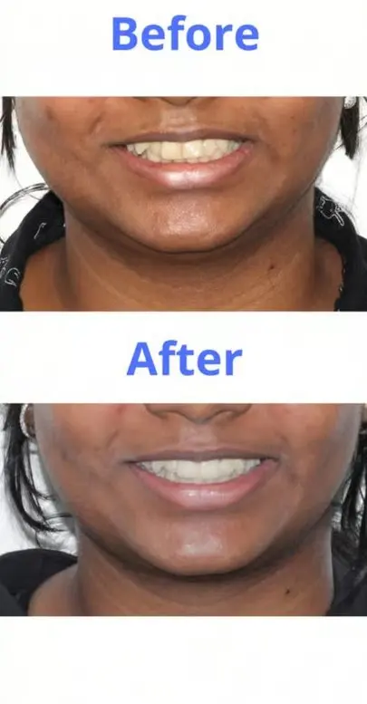 Patient smile transformation 5