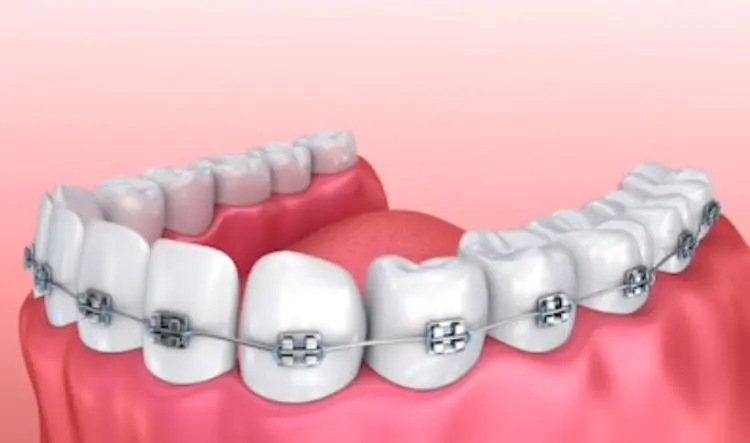 Metal braces on teeth