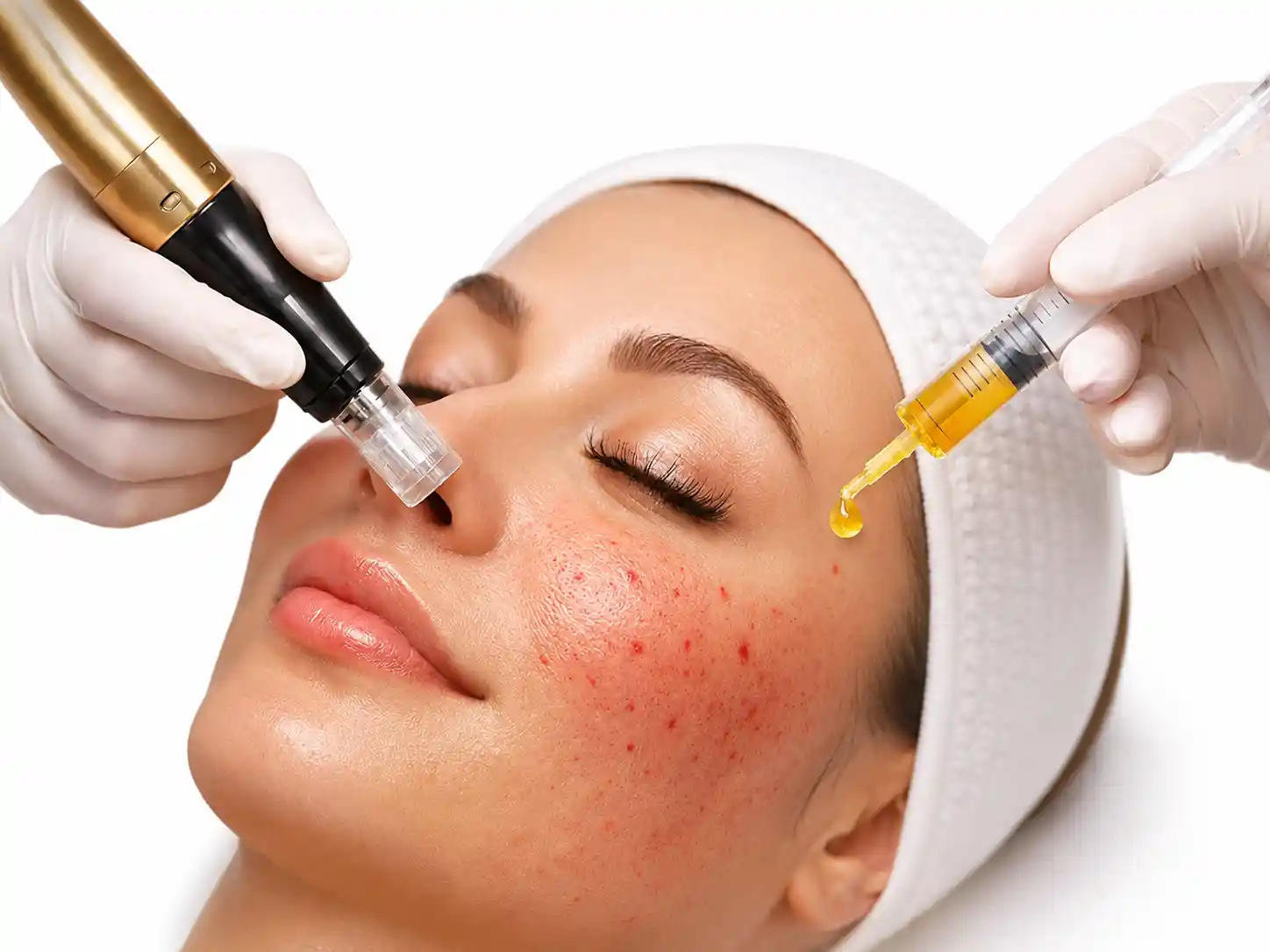 Photo Facial