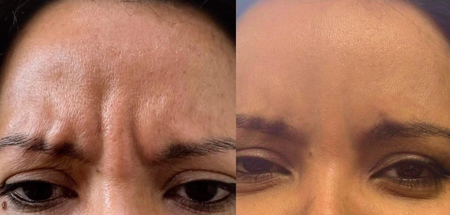 Before and after wrinkle relaxer, frown lines