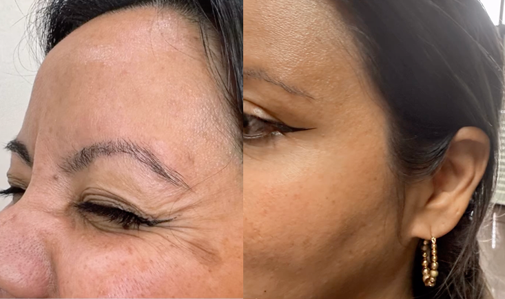 Before and after wrinkle relaxer treatment at GlowBar Oviedo
