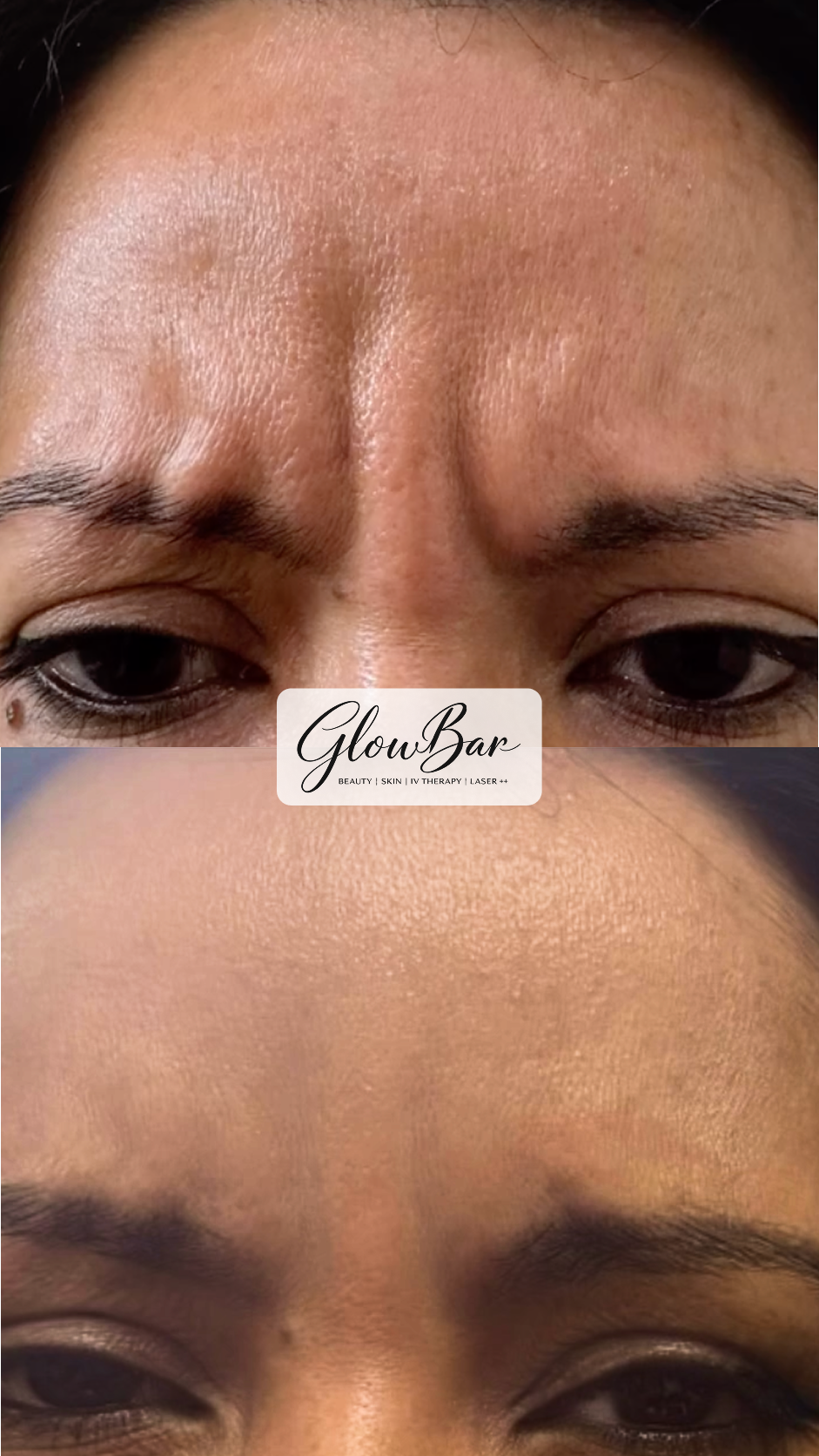 GlowBar before and after treatment comparison 4