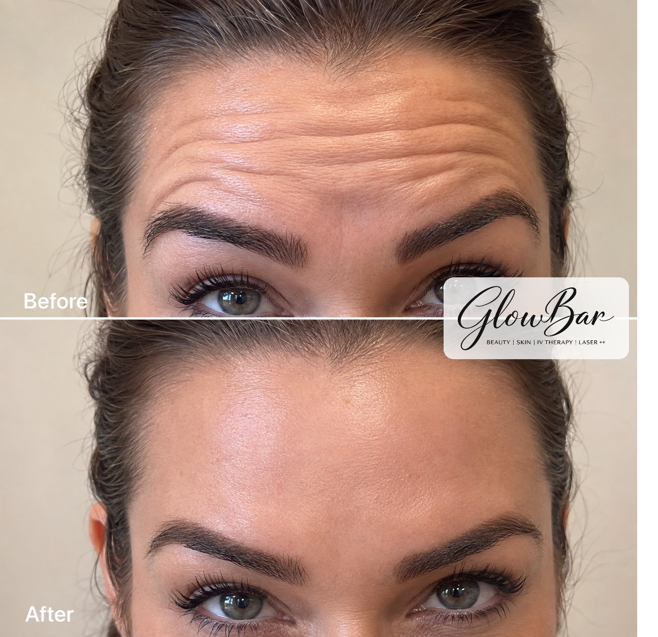 Before and after wrinkle relaxer treatment at GlowBar Oviedo