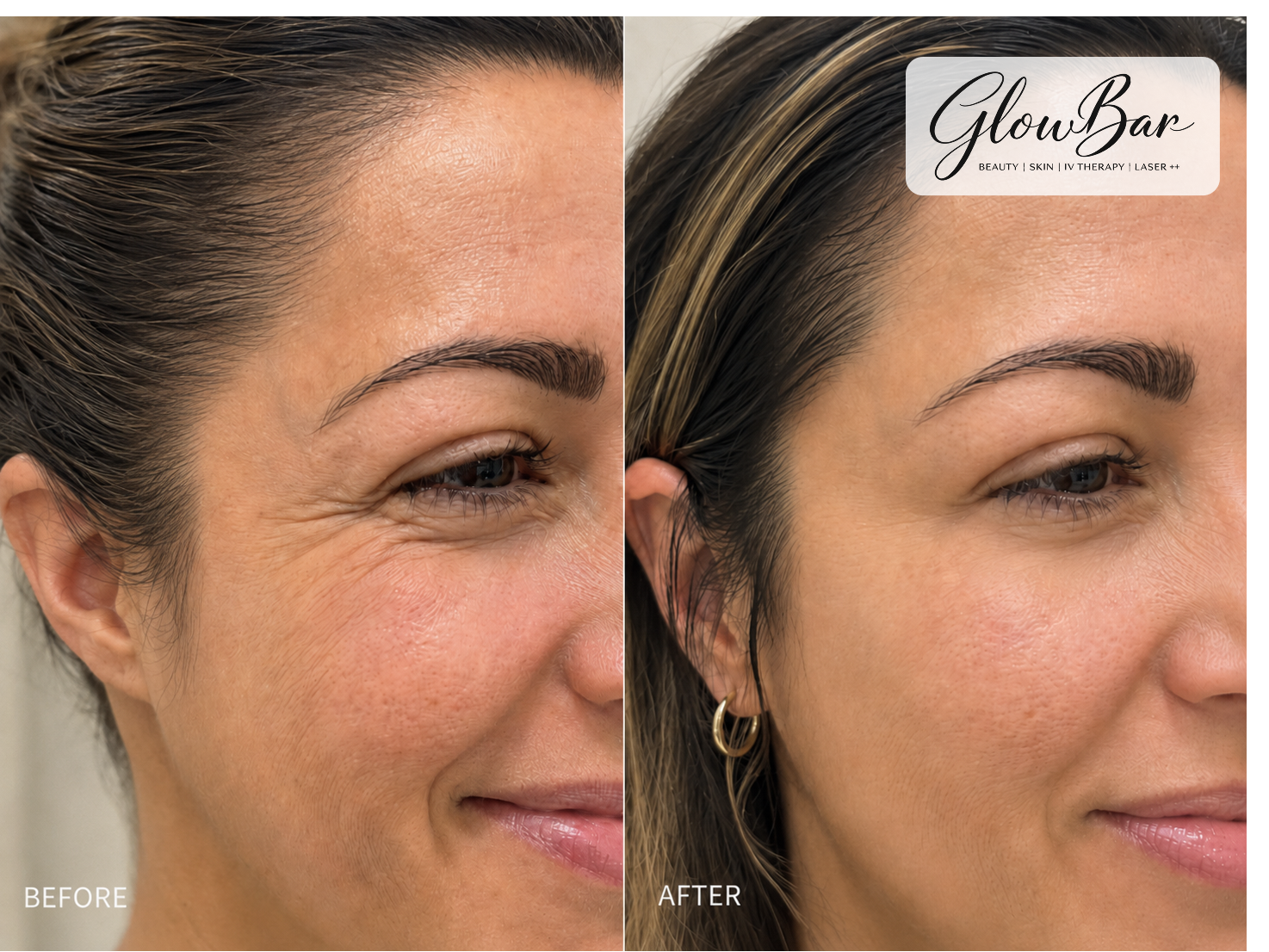 GlowBar before and after treatment comparison 1