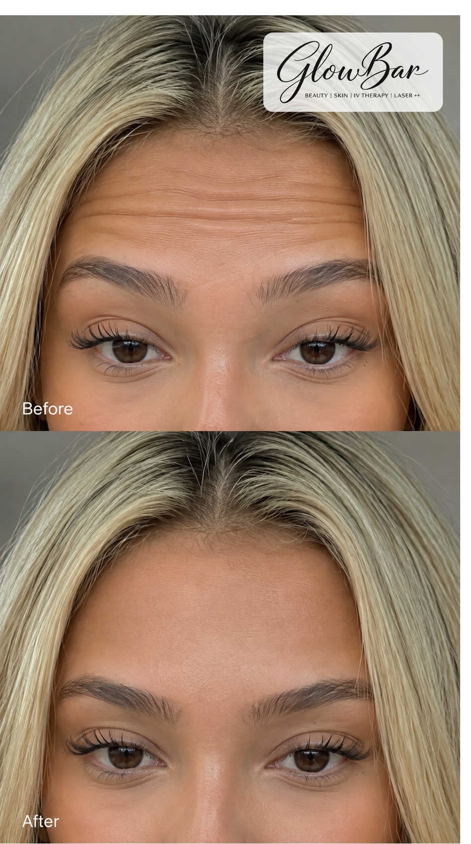 GlowBar before and after treatment comparison 3