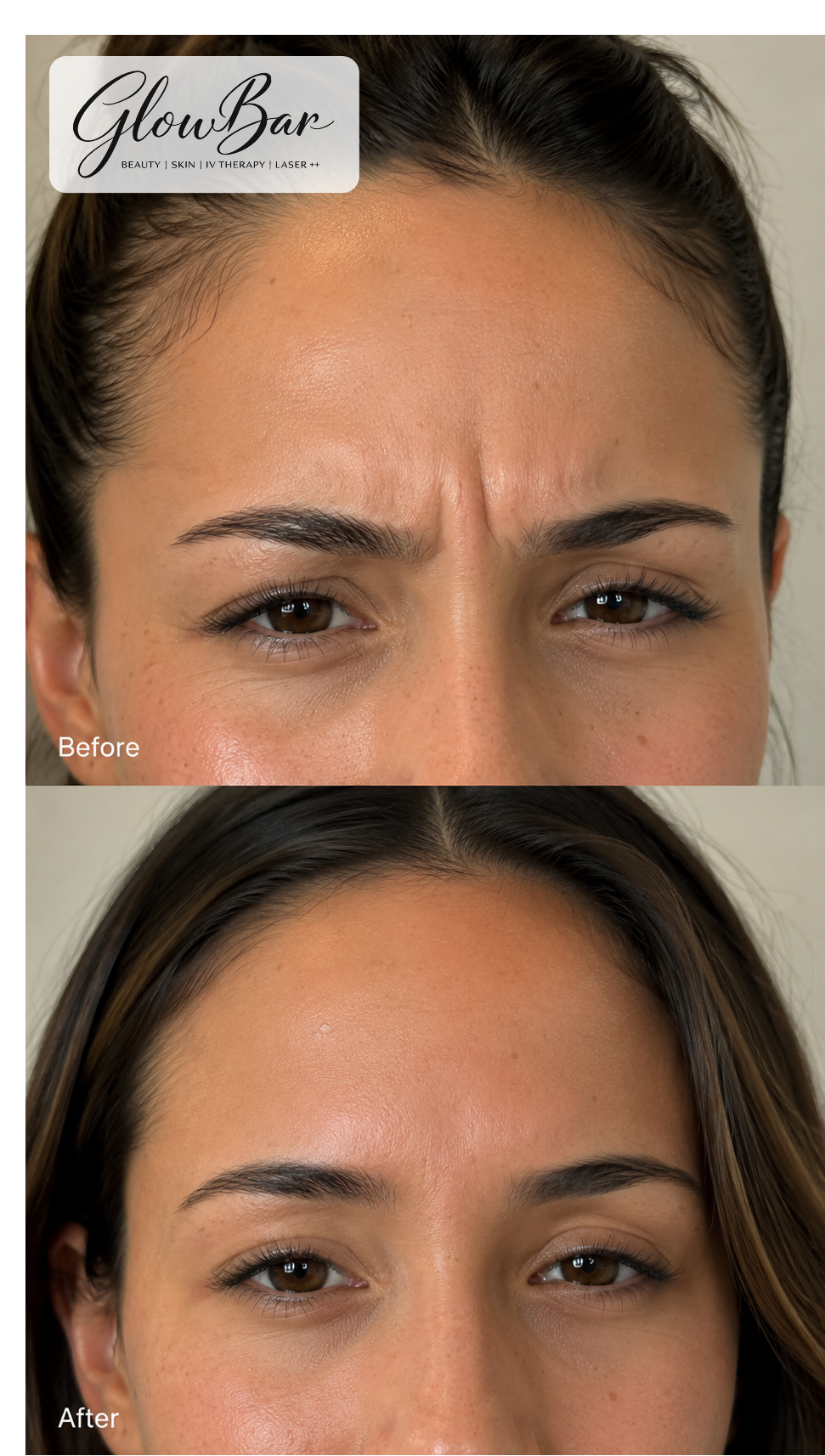 GlowBar before and after treatment comparison 5