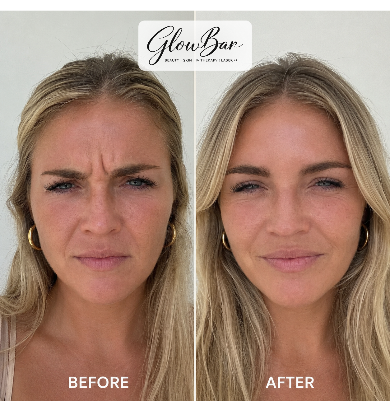 GlowBar before and after treatment comparison 2