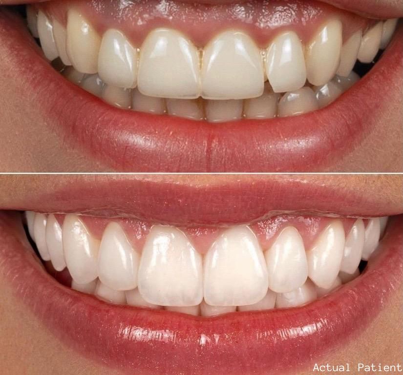 best porcelain veneers in malibu