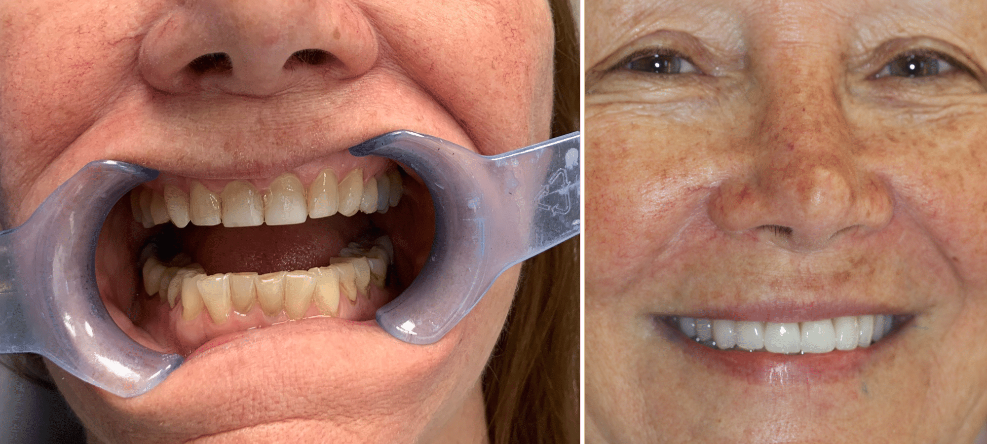 Veneers Before and After Process