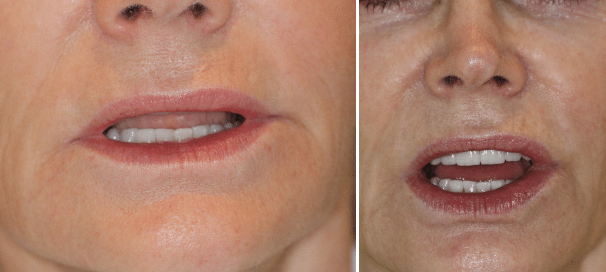 Porcelain Veneers Before and Afters