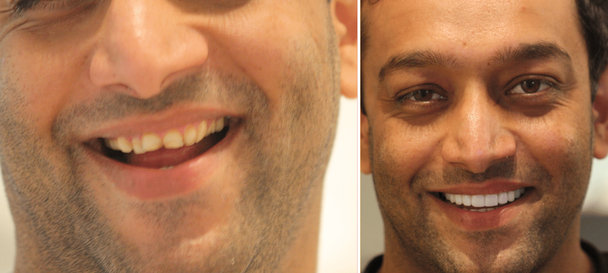 Porcelain Veneers Before and Afters