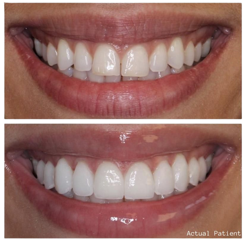 best porcelain veneers in los angeles
