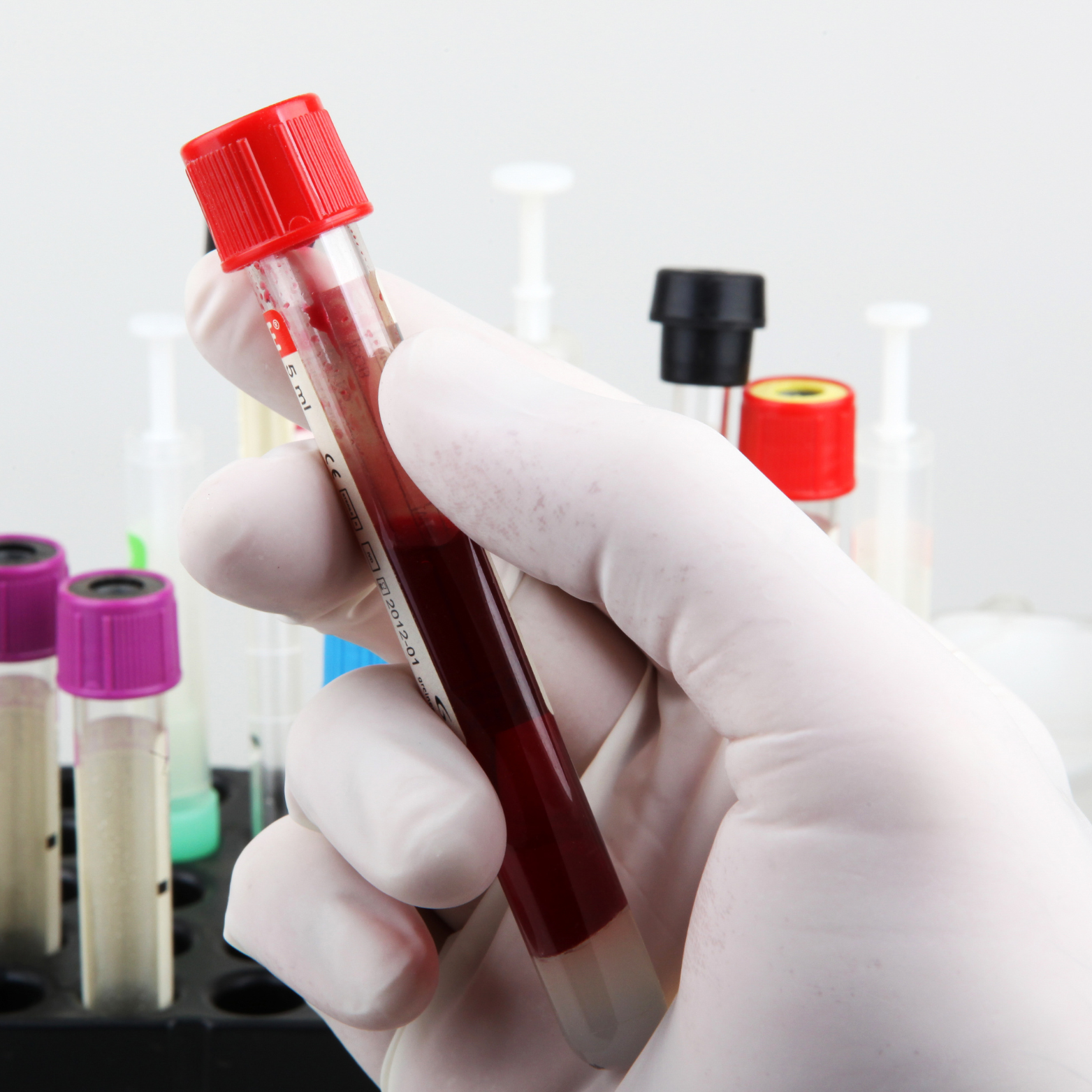 Vitamin B12 blood test for fatigue at Shamis Health & Beauty Enfield