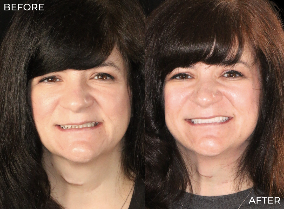Complete smile makeover transformation combining veneers crowns and implants at Just Wright Dental in Corsicana TX