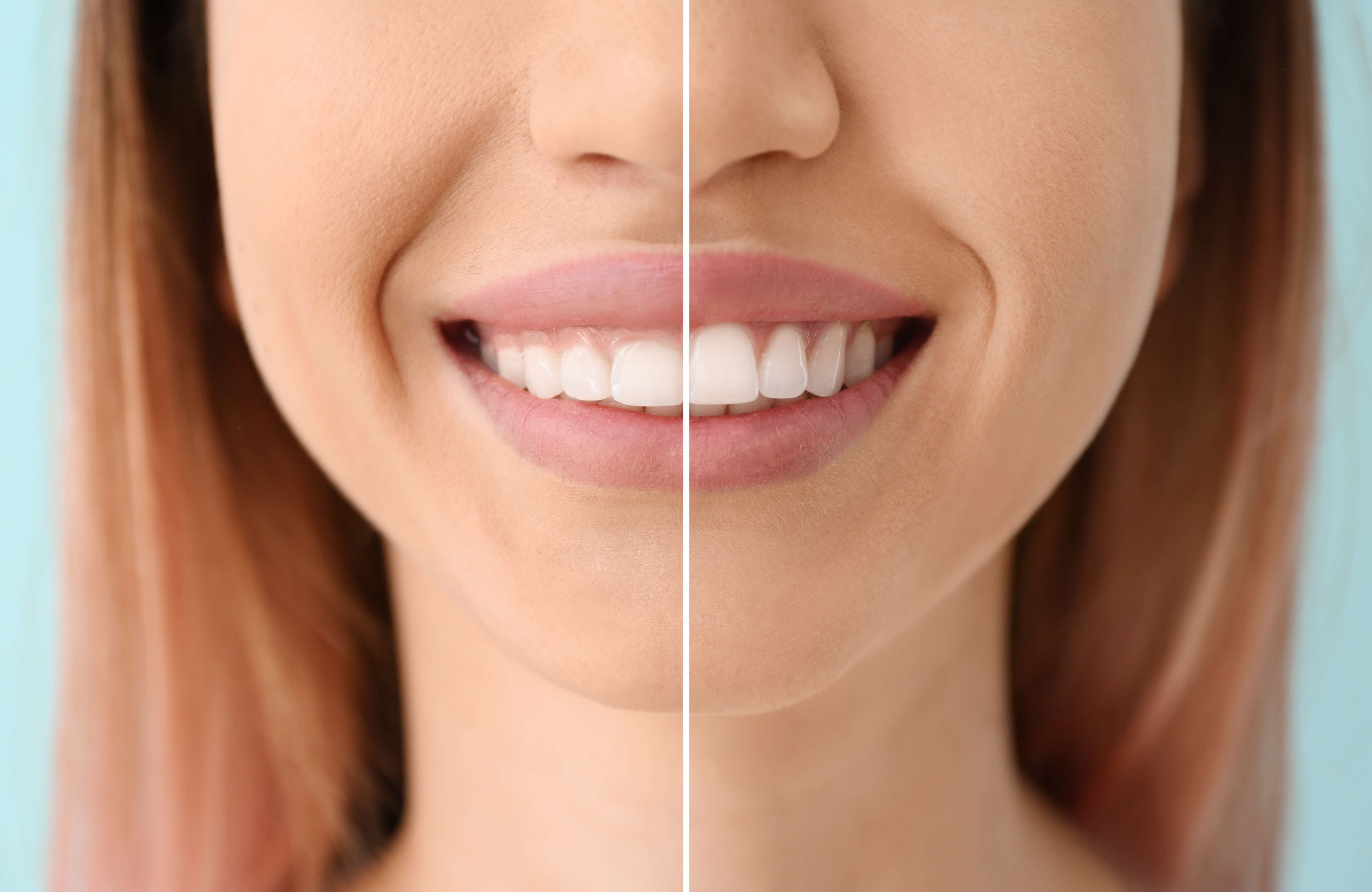 Laser gum contouring results for a balanced smile at Just Wright Dental in Corsicana TX