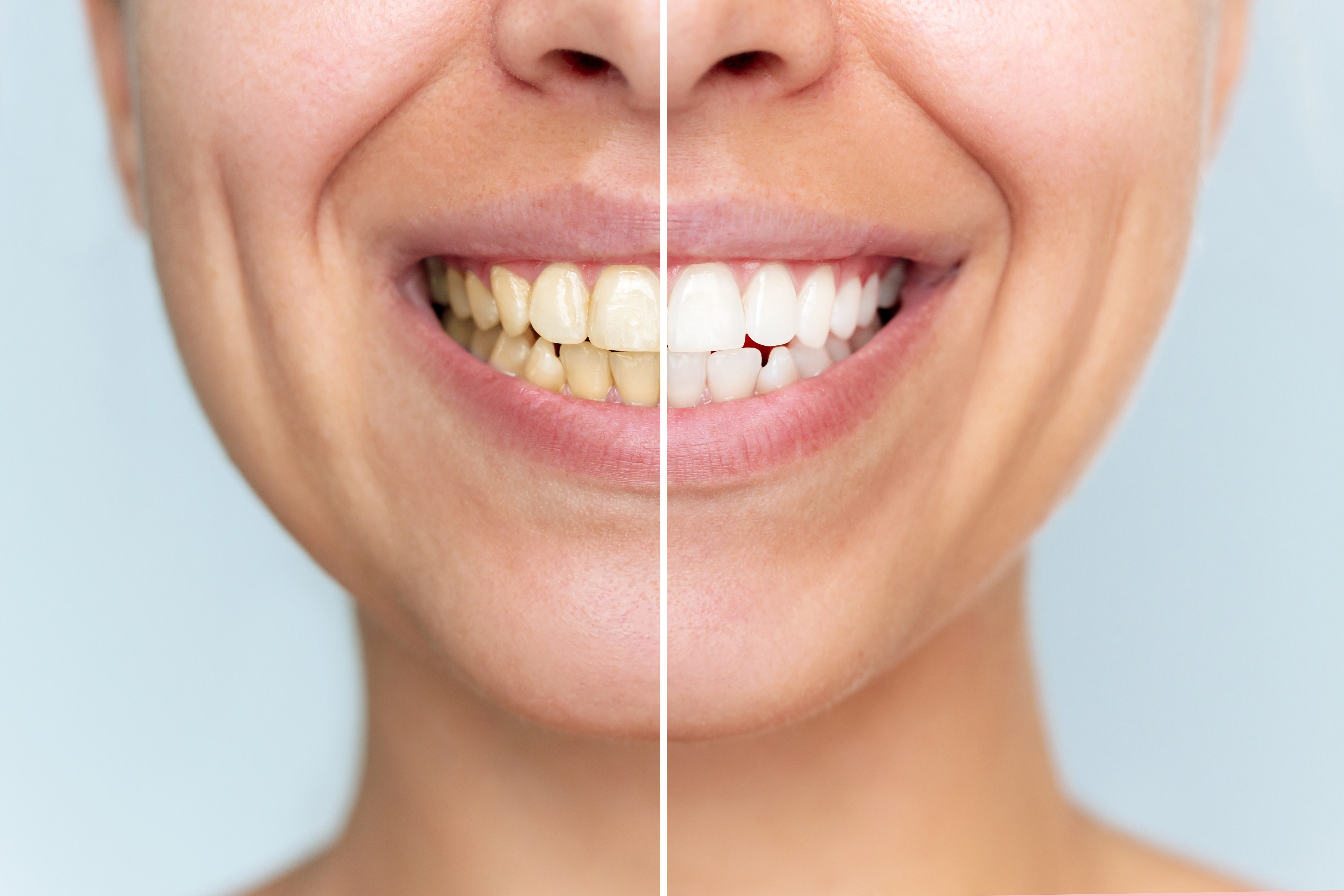 Professional teeth whitening results at Just Wright Dental in Corsicana TX