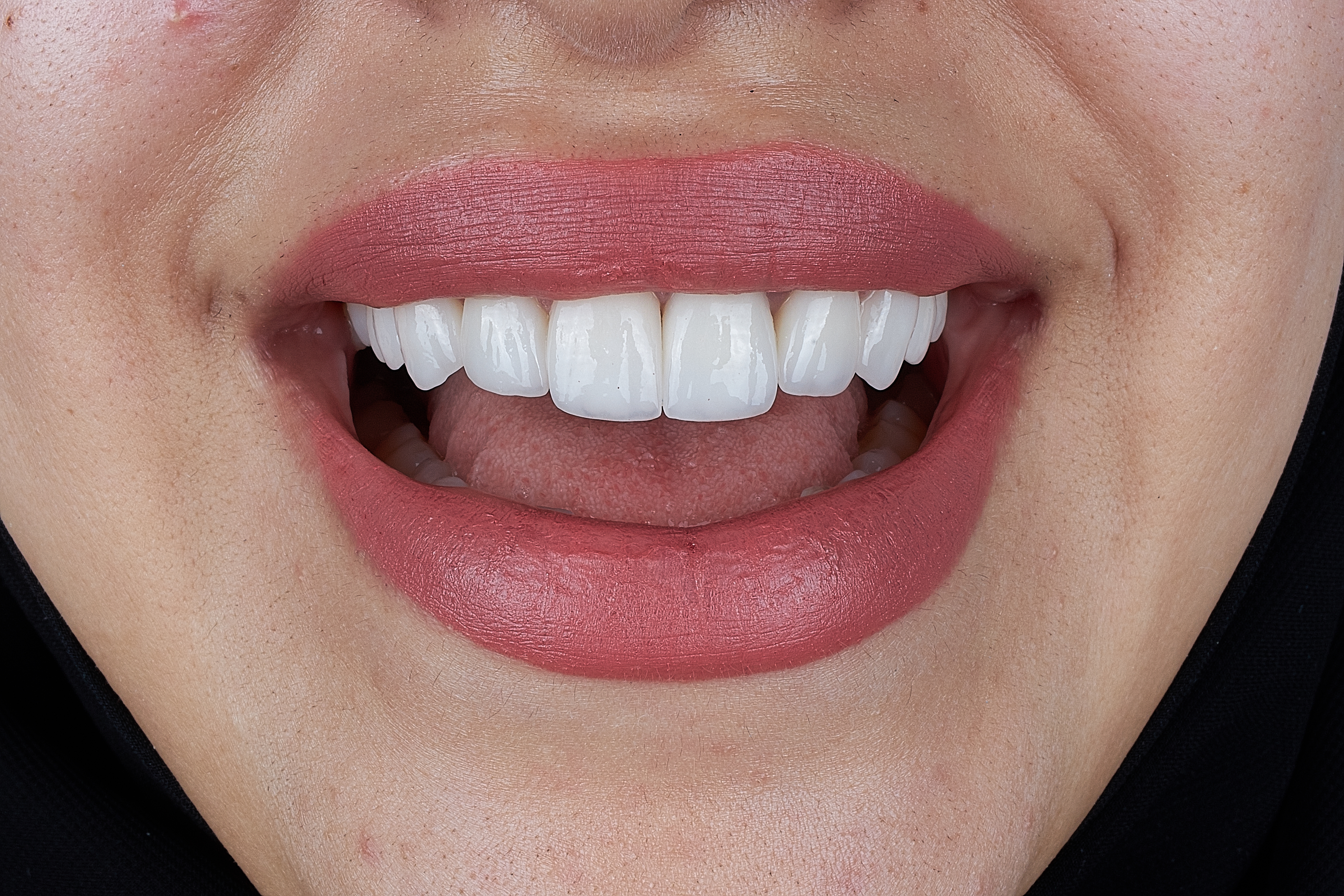 Dental bonding repair for chips and minor gaps at Just Wright Dental in Corsicana TX