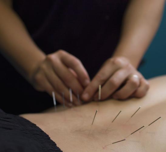 Acupuntura