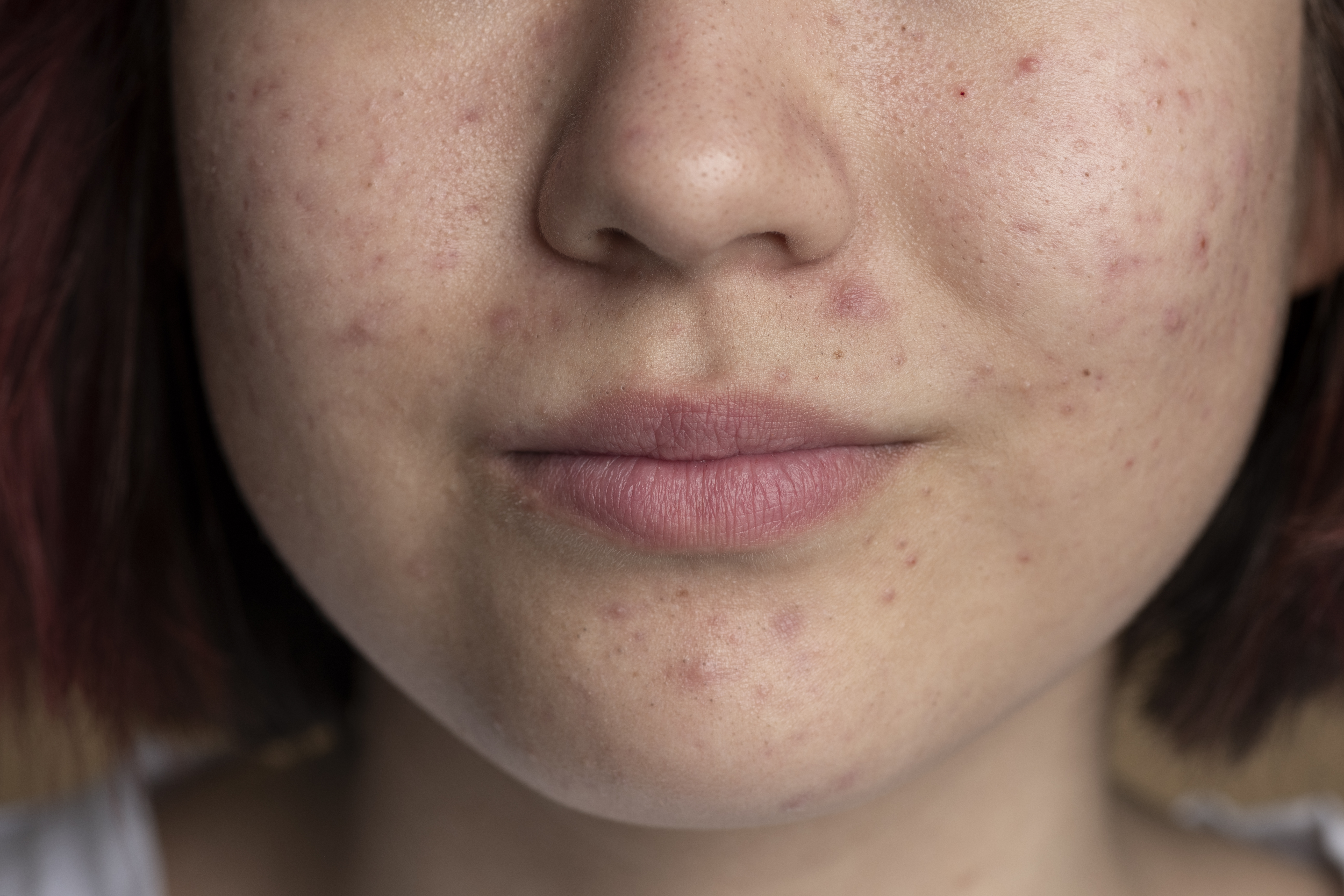 Acne & Scarring